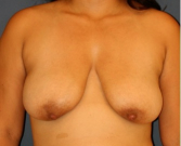 Feel Beautiful - Breast Lift 302 - Before Photo
